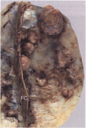 Close-up of a brown and black fungus AI-generated content may be incorrect.