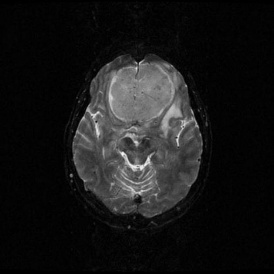 A close-up of a brain scan AI-generated content may be incorrect.