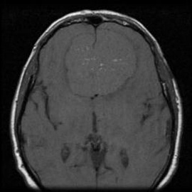 A close-up of a brain scan AI-generated content may be incorrect.