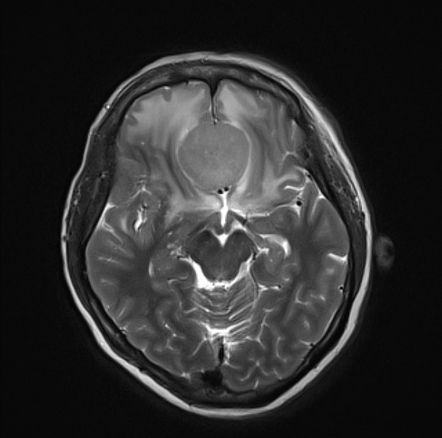 A close-up of a brain scan AI-generated content may be incorrect.