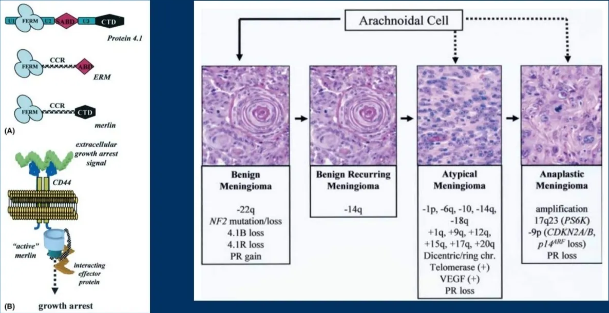 Molecular pathogenesis of meningiomas. nded CTD Protein 4. I ERM CCR (A) extracellular arrest "active" Arachnoidal Cell Benign Meningioma -22q NF2 mutation/loss 4.1B loss 4. IR loss PR gain Benign Recurring Meningioma -14q Atypical Meningioma -Ip, -6q, -10, -14q, +1q, +9q, +12q, +15q, +17q, +20q Dicentric/ring chr. Telomerase (+) V EGF (+) PR loss Anaplastic Meningioma amplification 17q23 (PS6K) -9p (CDKN2WB, p 144RF loss) PR loss (B) interacting effector growth arrest Perry et al. J Neurooncol DOI: 10.100%11060-004-2749-0. Journal of Neuro-OncoIogy 