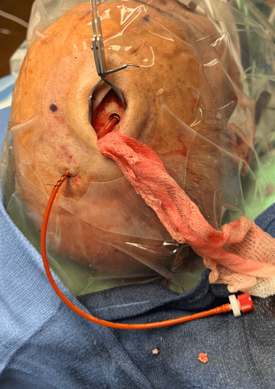 Dealing with dependent bleeding that always fills the bottom of your incision. Place a 4x4 and tuck it under scalp with a curved hemostat. Will not solve arterial pumpers but stops all annoying venous oozing.  