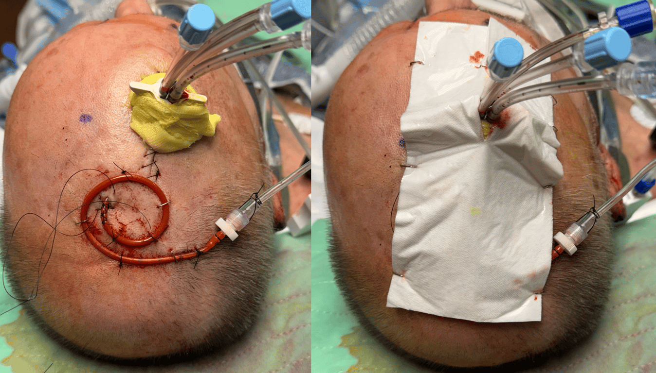 Figure 7: final product before (LEFT) and after (RIGHT) telfa placement. 