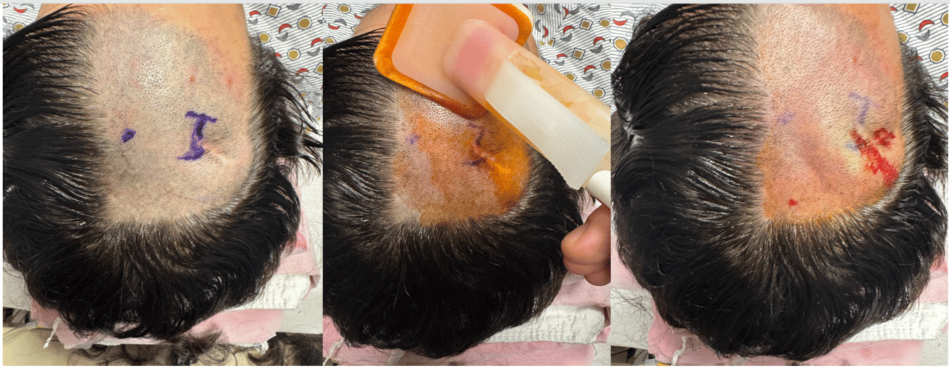 (LEFT) Kocher’s point with hair combed away from working area (in this case, patient had a prior incision from old ETV). (MIDDLE) chloroprep x 1 prior to injecting lidocaine widely (RIGHT).