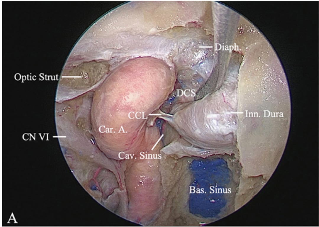 Optic Strut Cav. Sinus Bas. Sinus 