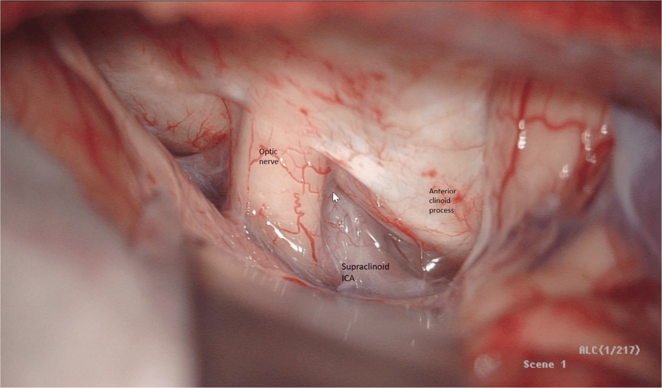 Lateral optic nerve. Optico carotid cistern to get even more CSF.