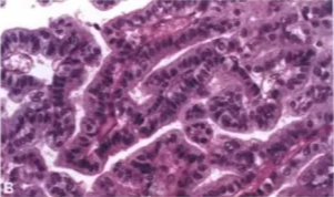 Fig. plen_ß A Well-diff—bated papillMY of a Engle of —phic B RegulM ff*niæd in 