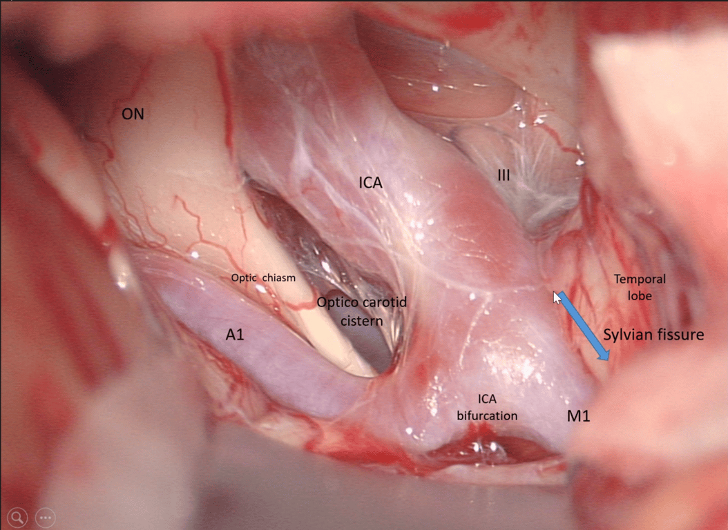Opticocarotid cistern