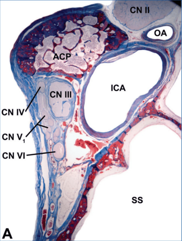Clinoidal segment C5 of the ICA