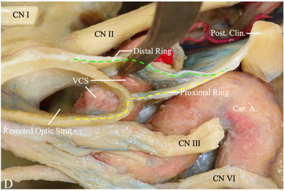 CNI CN 11 vcs uectCd.Optic 'Post. Clin. roxirnaÍ Rihg. CN 111 