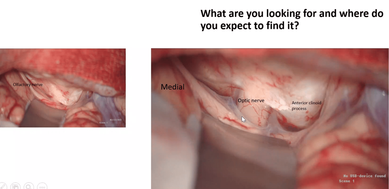 Pterional approach. See Optic nerve and get more CSF out