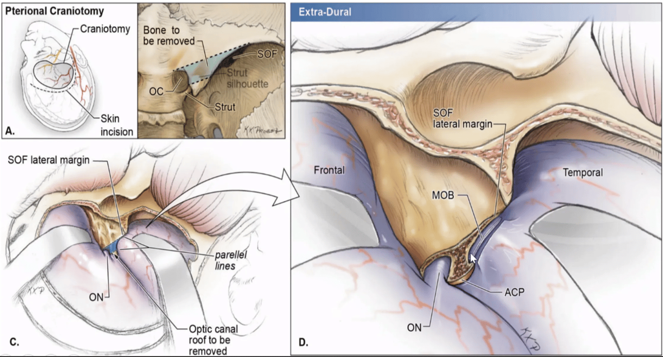 Meningo orbital band (MOB) and artery