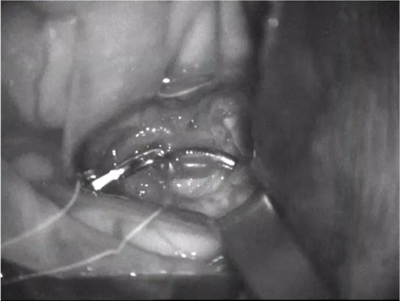 Indocyanine green angiography