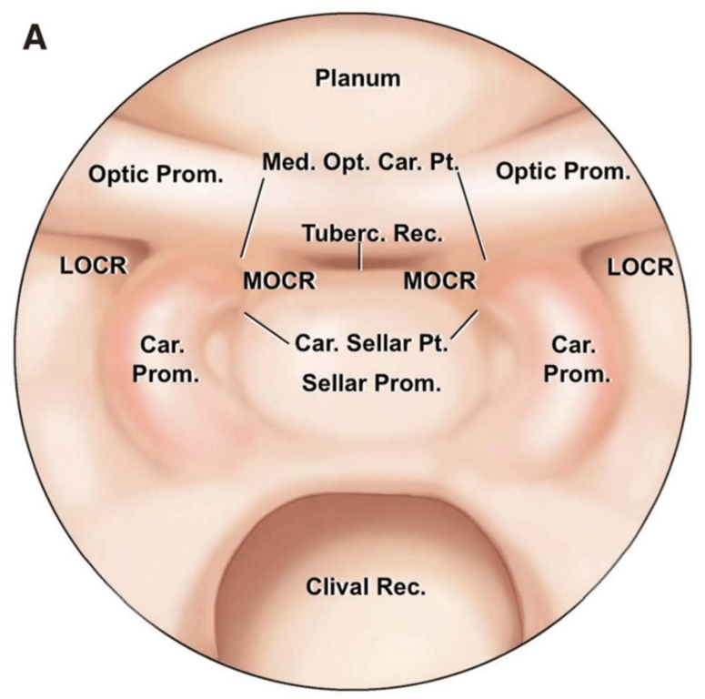 MOCR: medial optic carotid recess
