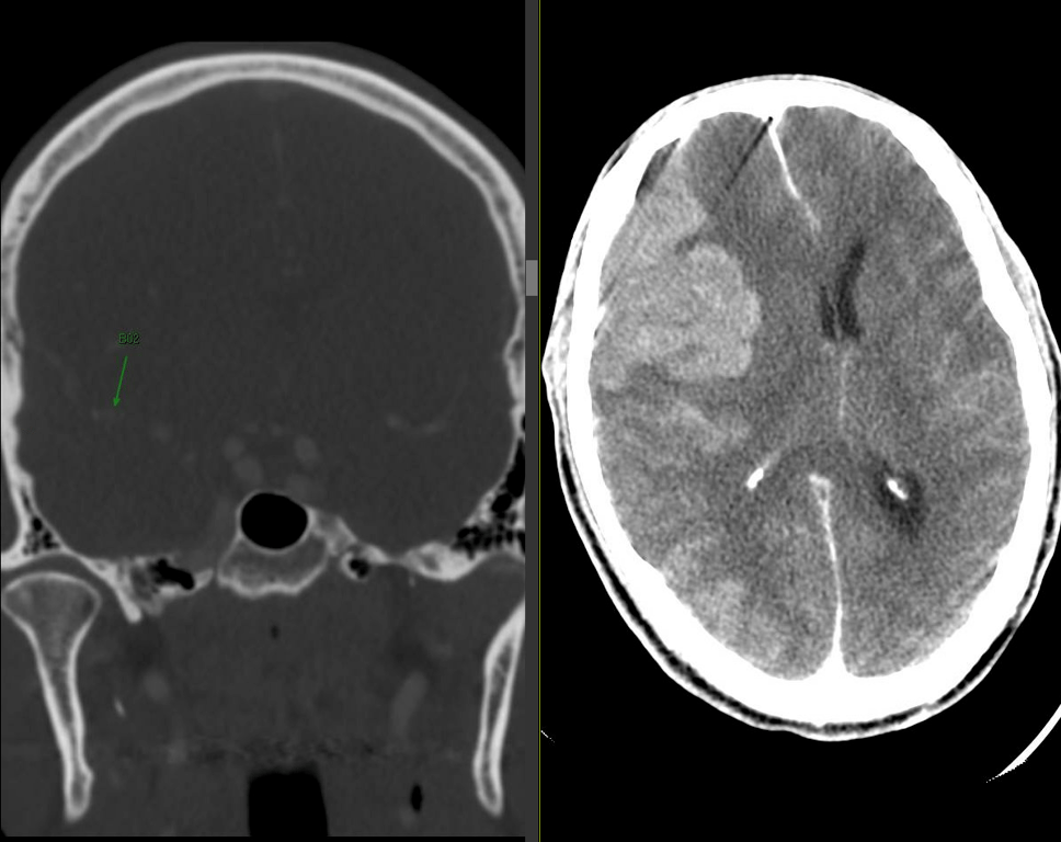 Elderly male with numerous cardiopulmonary comorbidities was found to have an abrupt M2 occlusion (LEFT) with resultant rapidly progressive malignant cerebral edema with sulcal effacement, midline shift. Note that hyperdensity is contrast staining and NOT hemorrhaghic transformation in this case.