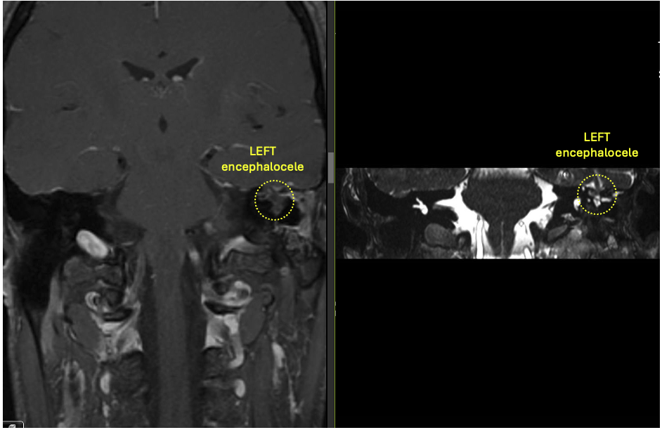 An associated encephalocele is demonstrated in the coronal plane on this patient’s pre-operative MRI skull-base with contrast fat-sat sequence (LEFT) and FIESTA (RIGHT). 