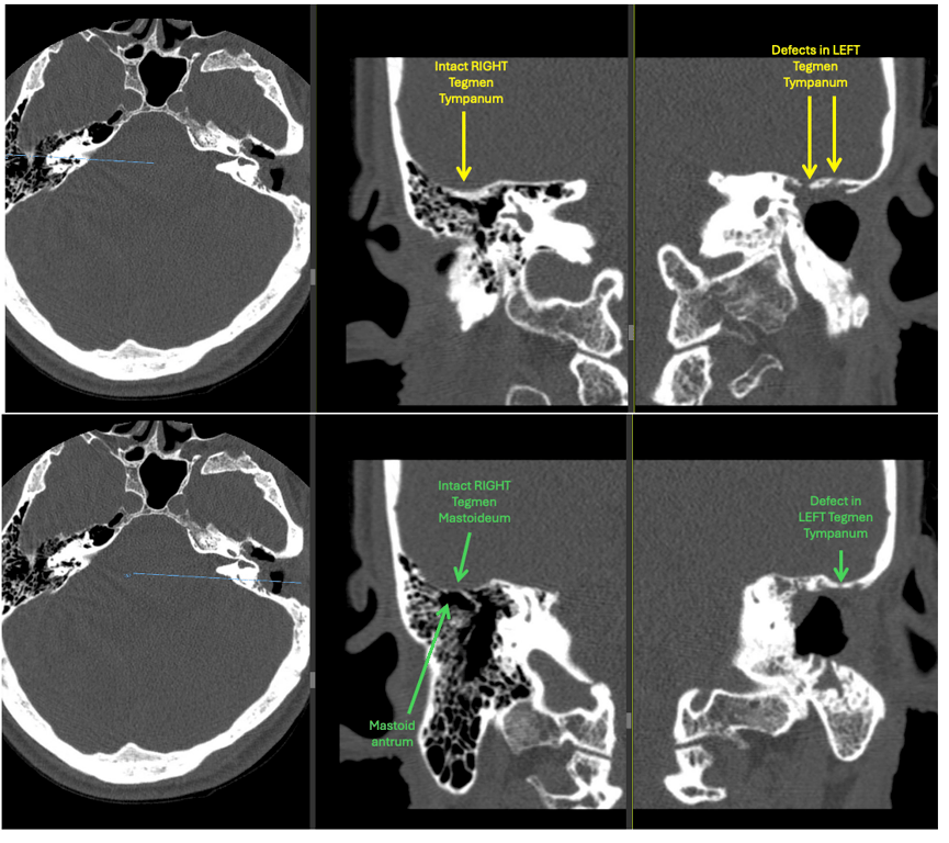 Normal tegmen tympanum and mastoideum on the right and defective tympanum/mastoideum on the left in a patient with history of a left cholesteatoma with a left canal, wall down tympanomastoidectomy who presented years later with CSF otorrhea on the left and underwent a L temporal craniotomy with temporal fascia repair.  
