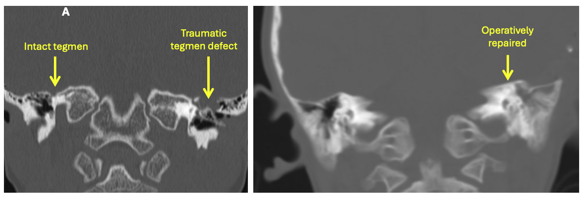 6 year old child who suffered fall off a bicycle with bilateral temporal bone fractures including displaced fracture of the L parietal calvarium with associated longitudinal fracture through L temporal bone sparing otic capsule. He underwent operative primary repair of fracture with cautery of a subtemporal meningoencephalocele and repair using tepmoralis fascia.  