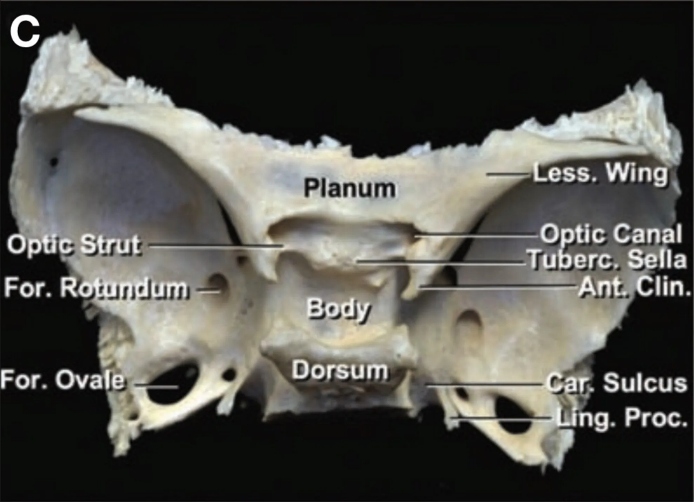 Superior view of the sphenoid bone. 