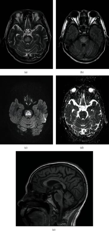 (a) T2 and (b) T2 FLAIR images demonstrating symmetric hyperintensities in the central pons; (c) axial diffusion weighted image; (d) ADC map demonstrating restricted diffusion changes in the central pons; (e) sagittal T1 image demonstrating hypointensities in the pons.