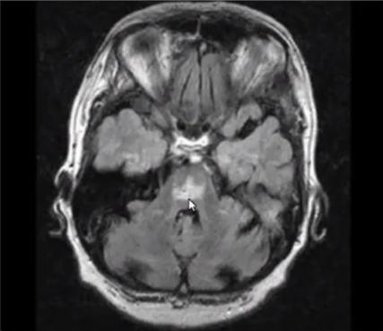 Osmotic demyelination syndrome White areas in the middle of the pons Massive demyelination of descending axons May take up to 2 weeks to manifest 