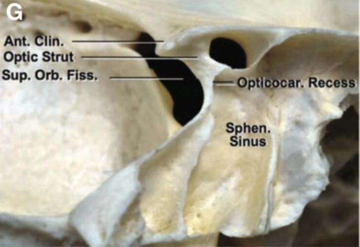 Posterior view of the left middle fossa and a lesser wing type of sphenoid sinus. 