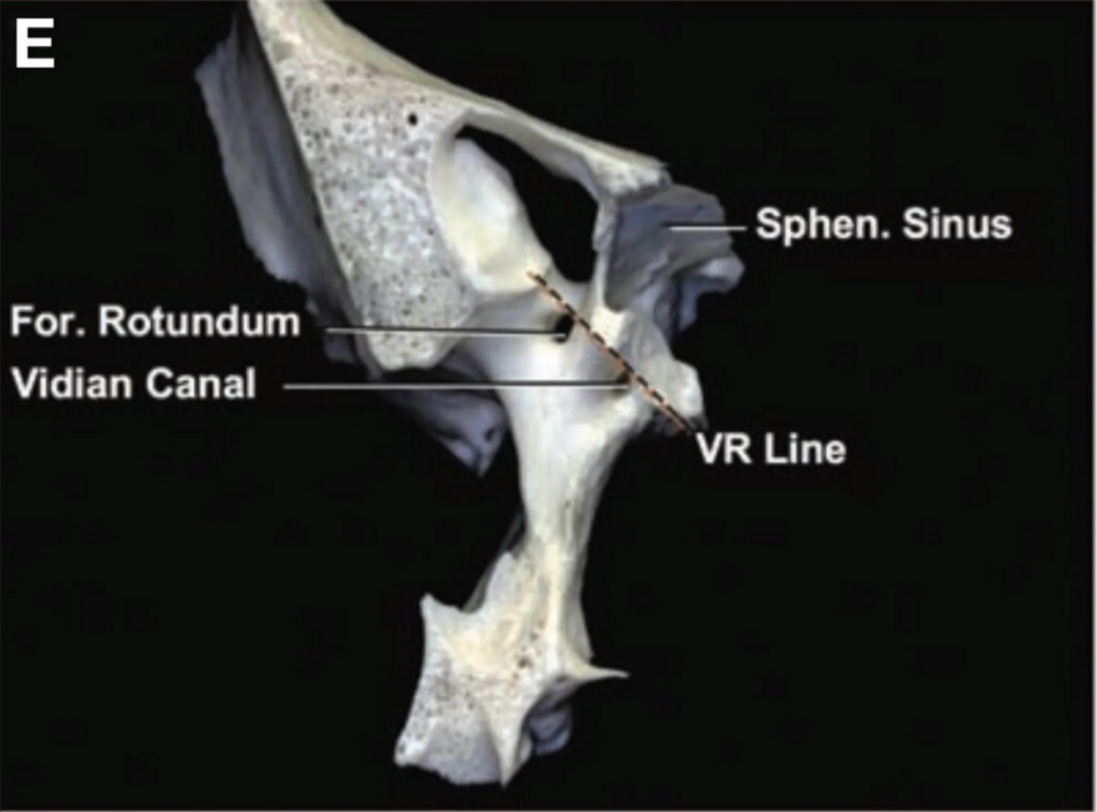Anterior view of the right half of the sphenoid bone showing a body type of sphenoid sinus. 