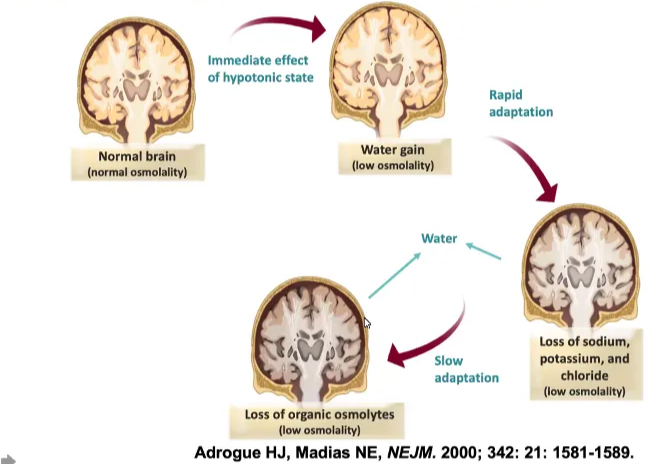The brain undergoes volume adaptation in response to gradual-onset hyponatraemia of hypotonic state adaptation Water pin Loss sodium. potassiu and chloride LOSS of orgaNc osnWVtes Adrogue HO, Madias NE, NEJM. 2000; 342; 21: 1581-1589. 