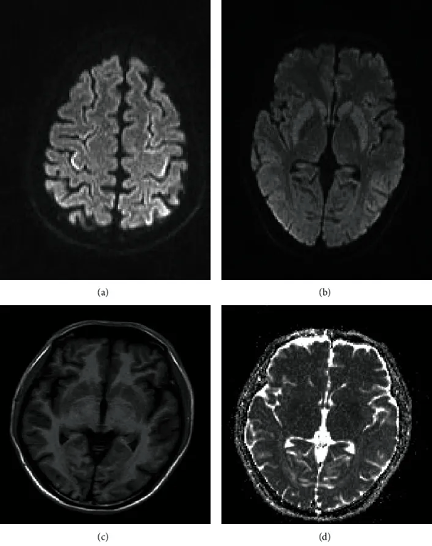 (a, b) axial diffusion-weighted images demonstrating restricted diffusion in the cerebral cortex and the basal ganglia; (c) T1 and (d) ADC map showing hypointensities in the basal ganglia; (e) T2 image demonstrating symmetric hyperintensities in the basal ganglia
