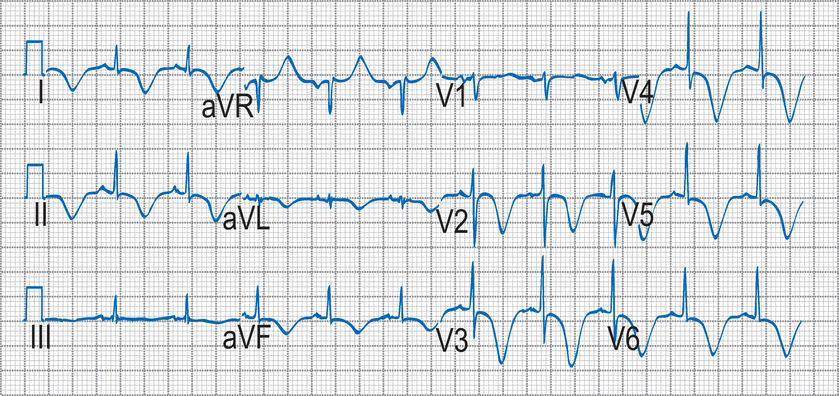 A graph of a heart rate AI-generated content may be incorrect.