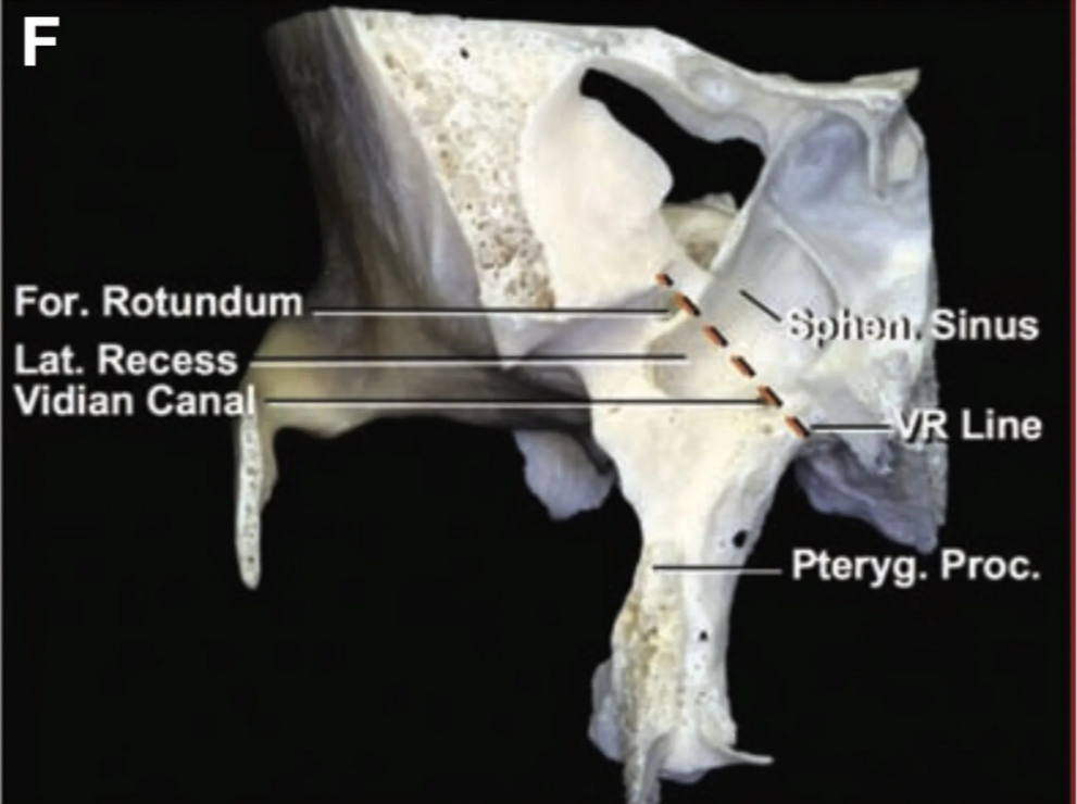 Anterior view of a lateral type of sinus 