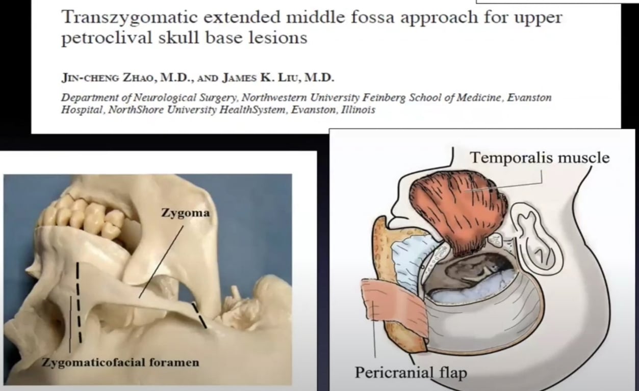Transzygomatic extended middle fossa approach for upper petroclival skull base lesions JIN-CHENG ZHAO, M.D., AND JAMES K. Lit', M.D. Department of Neurological Surgery. Northwestern University Feinberg School of Medicine. Evanston Hospital. NorthShore University HealthSystem. Evanston. Illinois Temporalis muscle Zygoma 1 Zygomaticofacial foramen Pericrania flap 