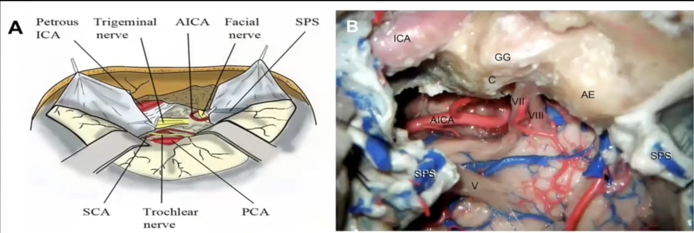 Petrous ICA Trigem inal nerve AICA Facial nerve PCA SPS ICA SCA Trochlear nerve 