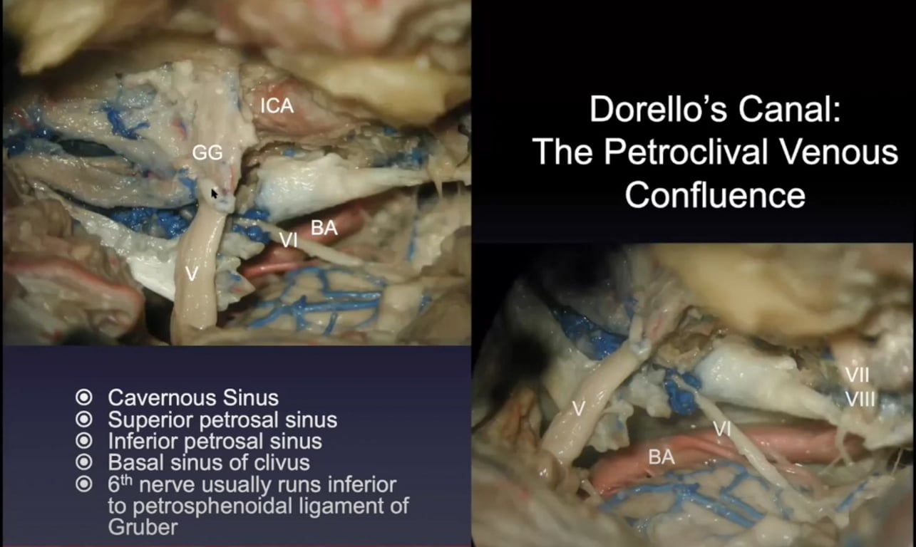 Dorello's Canal: The Petroclival Venous Confluence vili Cavernous Sinus Superior petrosal sinus Inferior petrosal sinus Basal sinus of clivus 6th nerve usually runs inferior to petrosphenoidal ligament of Gruber 