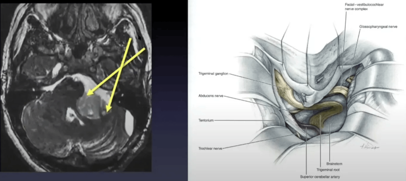 •ostero-medial Angle of Attack 
