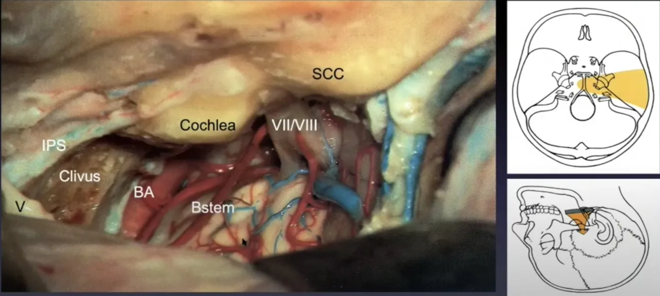 Anterior Petrosal Approach (Kawase, Extended MF) scc Vil/Vlll Cochlea Clivus 