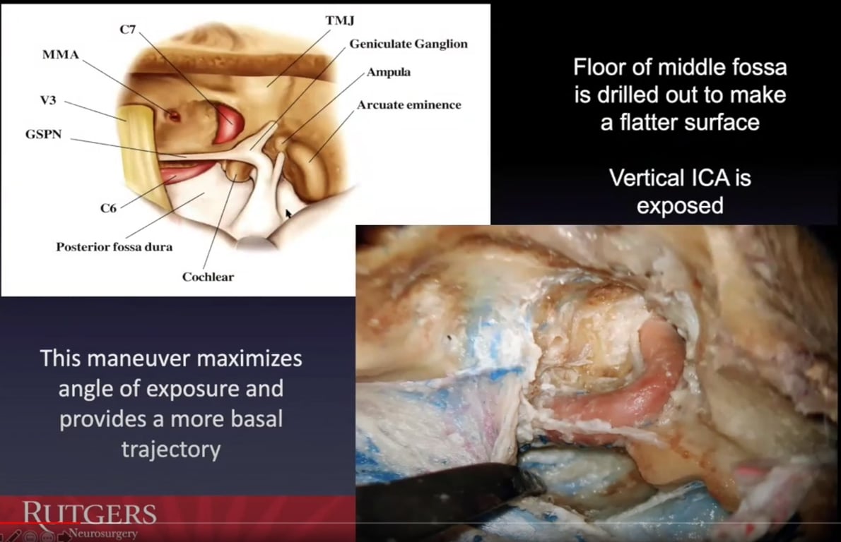 MMA GSPN Posterior fossa dura Cochlear This maneuver maximizes angle of exposure and provides a more basal trajectory RI ITGERS TMJ Geniculate Ganglion Floor of middle fossa is drilled out to make Arcuate eminence a flatter surface Vertical ICA is exposed 