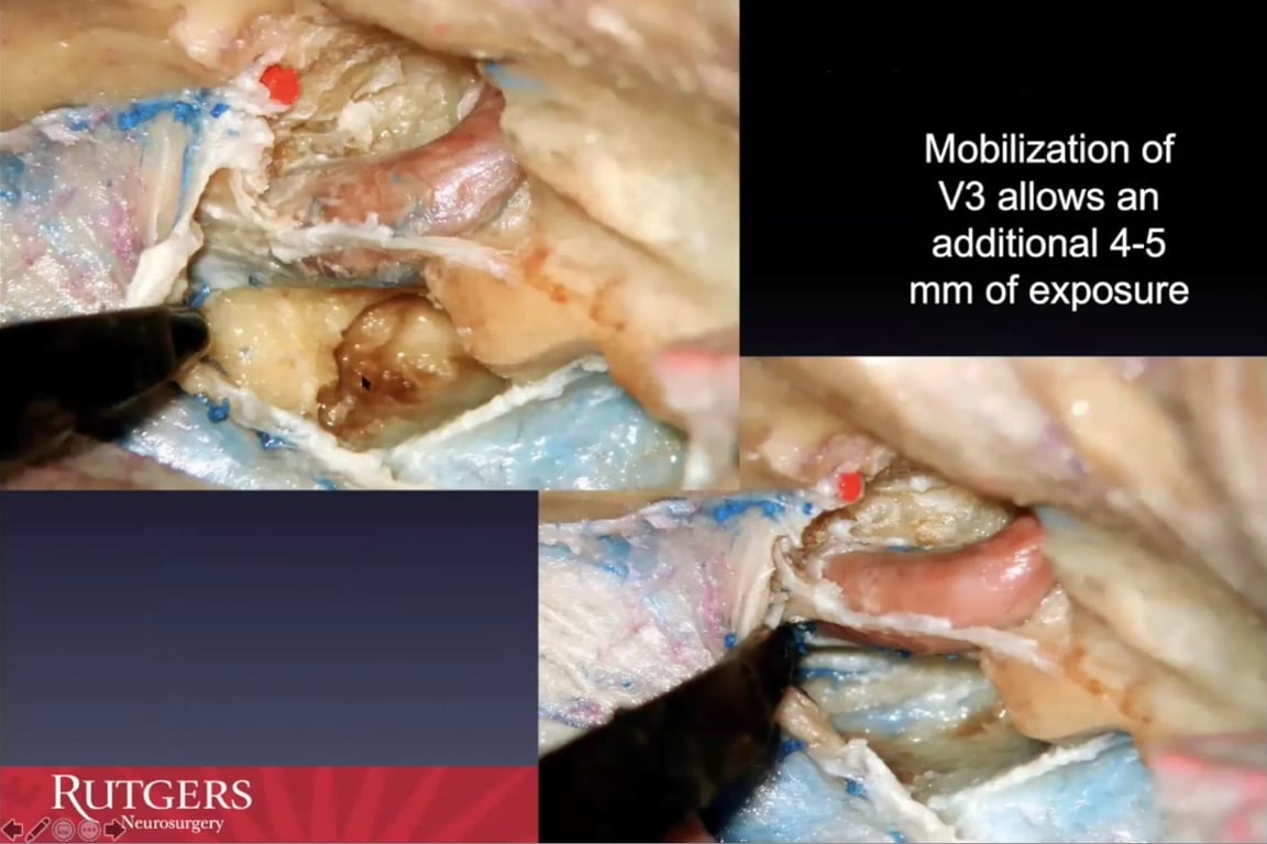 Mobilization of V3 allows an additional 4-5 mm of exposure UTGERS eurosurgery 