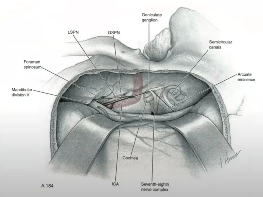 Navigating the Middle Fossa dension V Cochlea R184 nerw ccynplex 