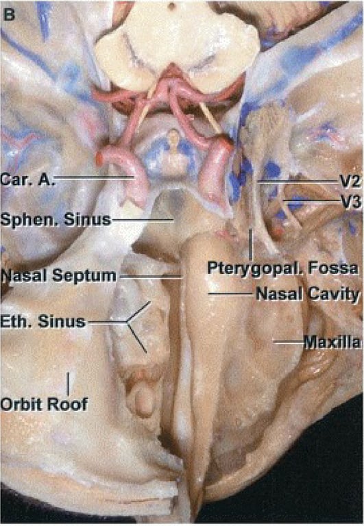 Sphen. Si a Septum Eth. Sinus Orbit Roof PterygOpa1b F0SS Nasa av- 