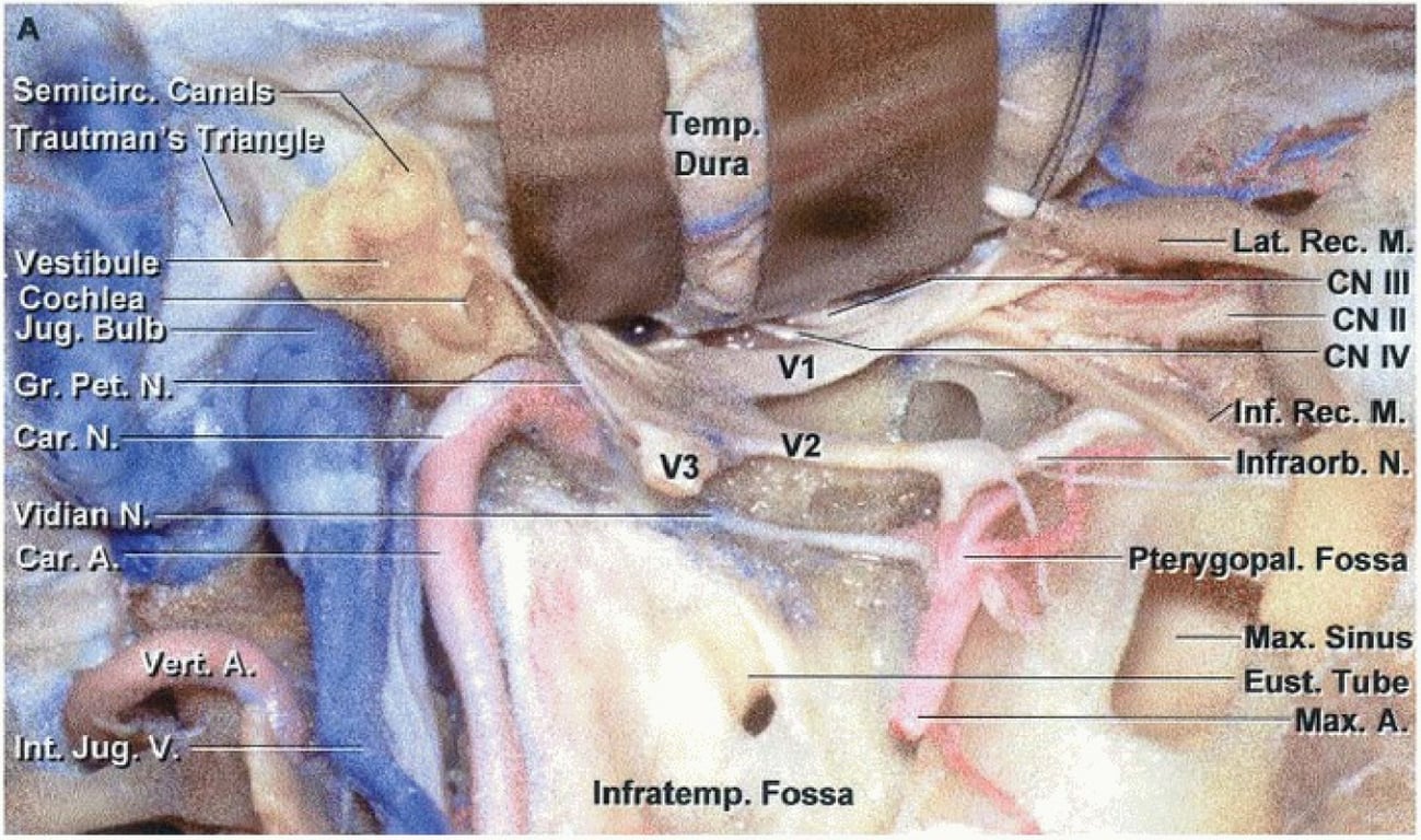 The bone and structures lateral to the orbit, infratemporal, and pterygopalatine fossa, and the parapharyngeal space and petrous part of the temporal bone have been removed to expose the structures below the anterior, middle, and posterior cranial base. 
The lateral part of the temporal bone has been removed to expose the cochlea, vestibule, and semicircular canals.