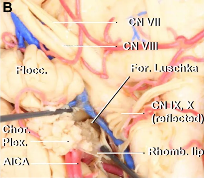 Cranial nerves IX and X are reflected medially. 