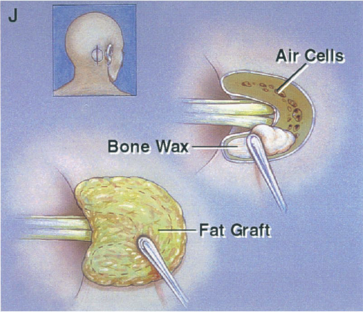 Air Cells Bone Wax Graft 