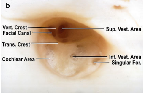 Vert Crest Facial Canal Trans. Crest , Cochlear Area — Sup. Wst. Area Vest. Area Singular For. 