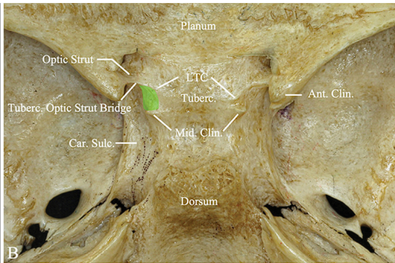 — AGL Clin. TubereÅtic u.. Car. Sul' ' Dorsuin 