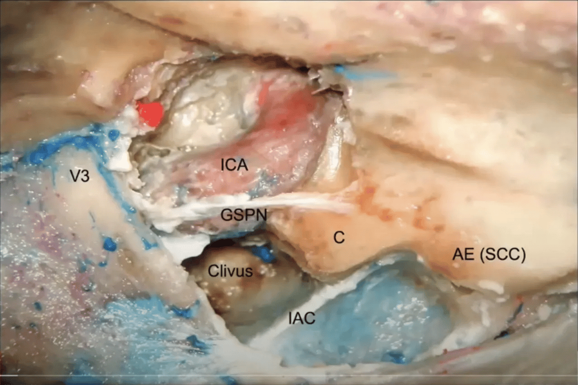 Drilling of Glasscock, Premeatal and Kawase Triangles ICA GSP AE (SCC) 