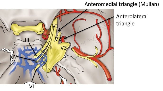 Schematic drawing of the middle fossa approaches using the anteromedial and anterolateral triangles