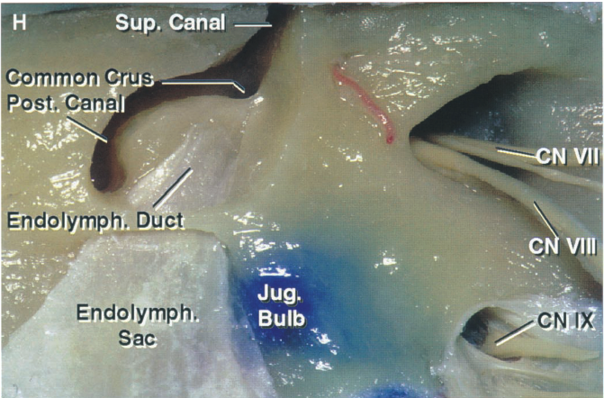 Sup. Canal Common Crus Post. Cana Endolymph. Duct Endolymph. Sac Jug. Bulb Vil C Vill CNI 