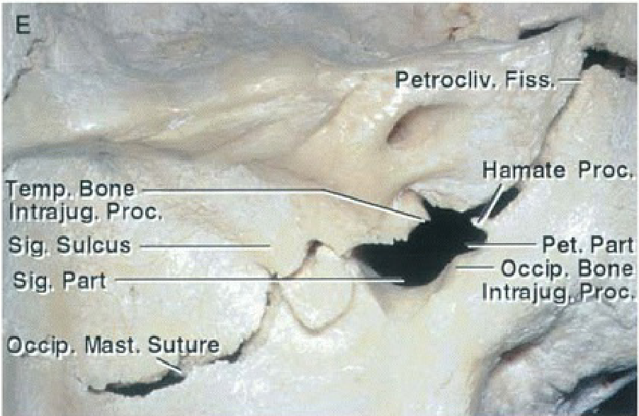 The sutures have been forced open 