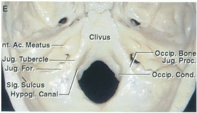 Clivus nt Ac. Meatus ug. Tubercle —L Jug..For. Sig. Sulcus Hypogl. Canal Occip. Bon Jug. Proc. Occip. Cbnd 
